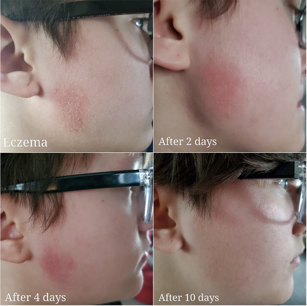 Little Known Natural Remedies for Controlling Acne